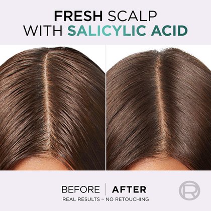 The top of the hair after using pure hyaluron serum with salicylic acid for fresh roots