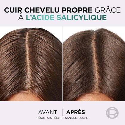 Le haut de la chevelure après l'utilisation du serum hyaluron pure avec de l'acide salicylique pour des racines fraiches